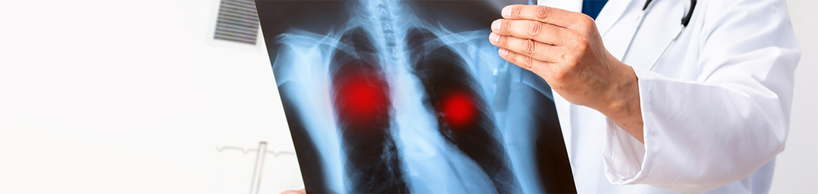 Tuberculoza: simptome, diagnostic, tratament