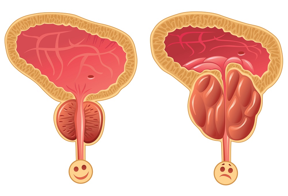 Adenomul de prostată: cauze, simptome, posibile complicații, diagnosticare și tratament