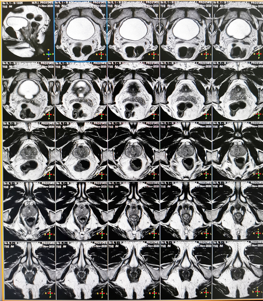 tratamentul prostatitei cu medicamente que es el cáncer de próstata