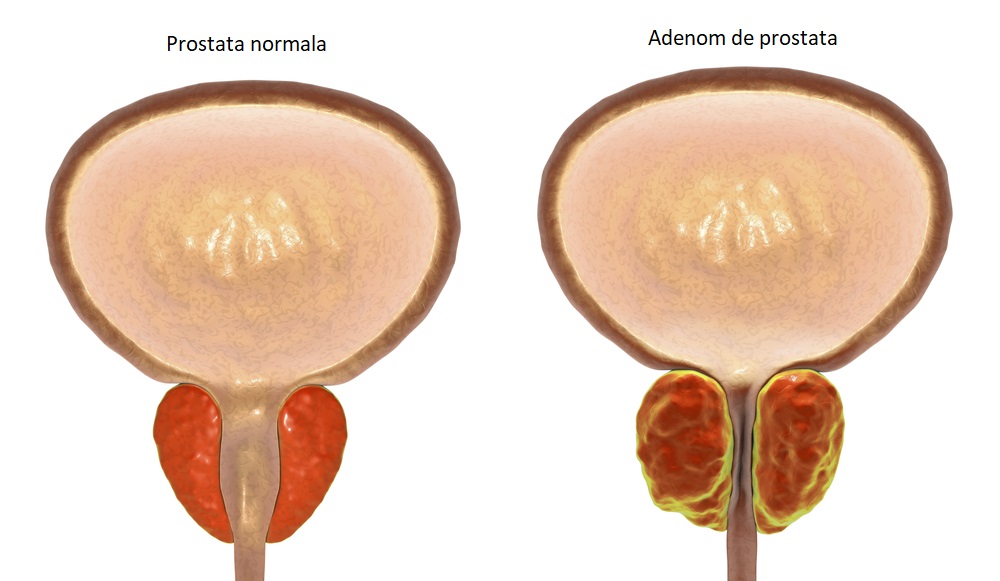 Ce sunt adenoamele de prostată, conditii medicale, tratamentul