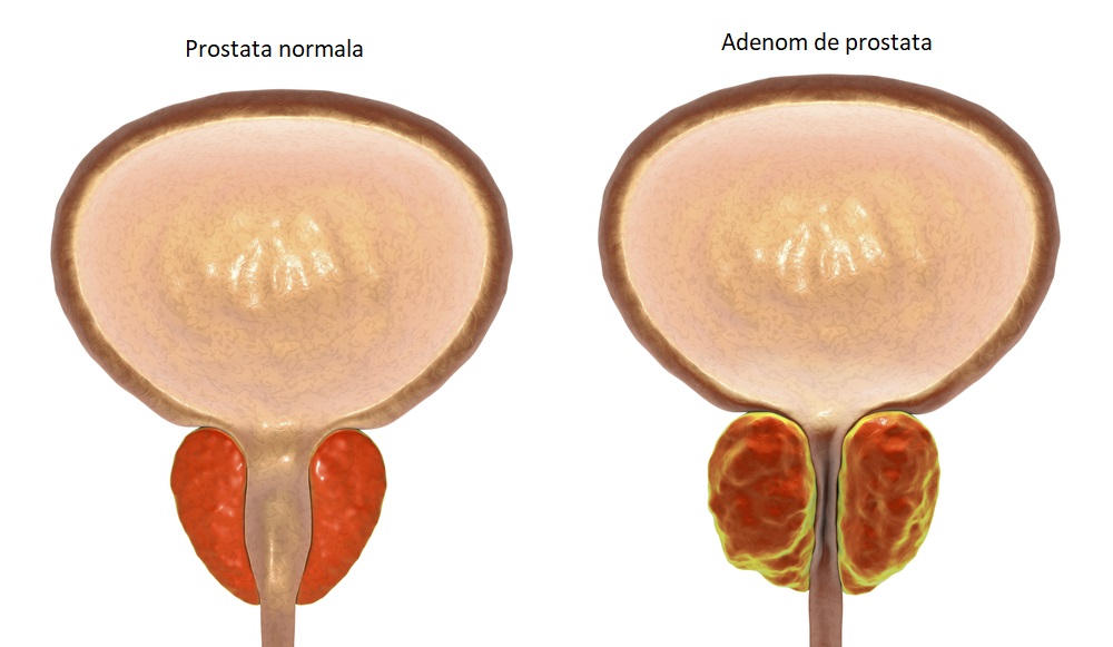 tratamentul complex al adenomului de prostată)