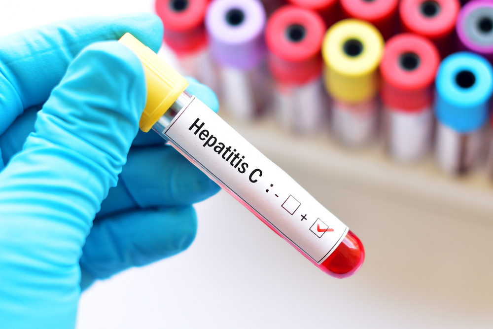 Analize hepatita