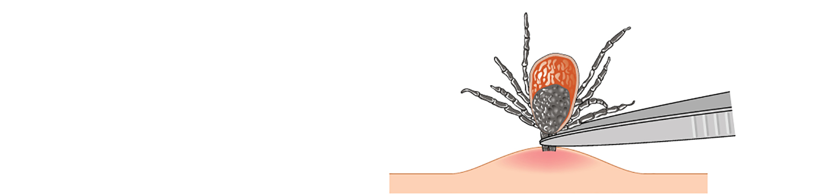 Boala Lyme (sau Borrelia Burgdorferi ADN)