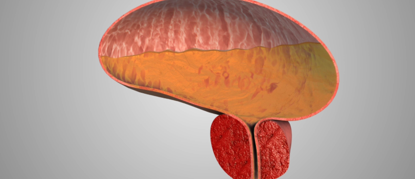 Prostata mărită (adenomul de prostată): ce este, cum se manifestă și cum poți ține sub control eficient simptomele
