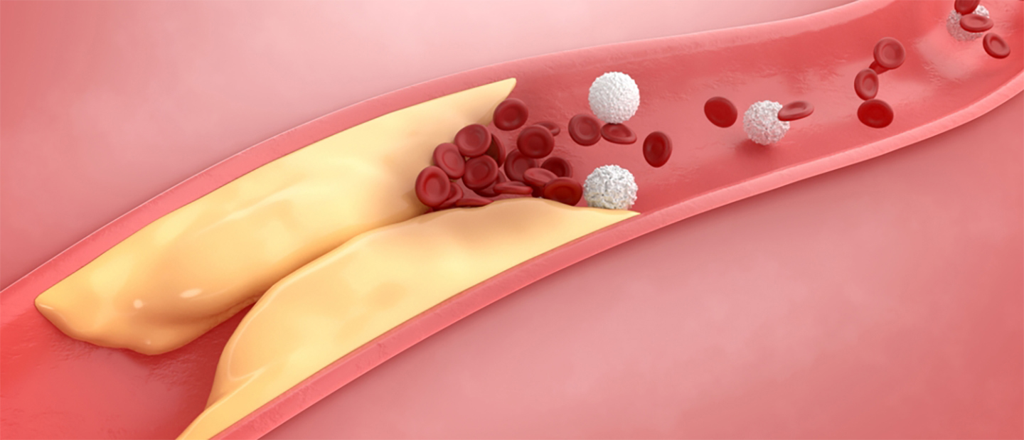 Ateroscleroza: cauze, simptome, tratament, complicatii