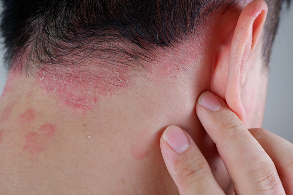 psoriazis2