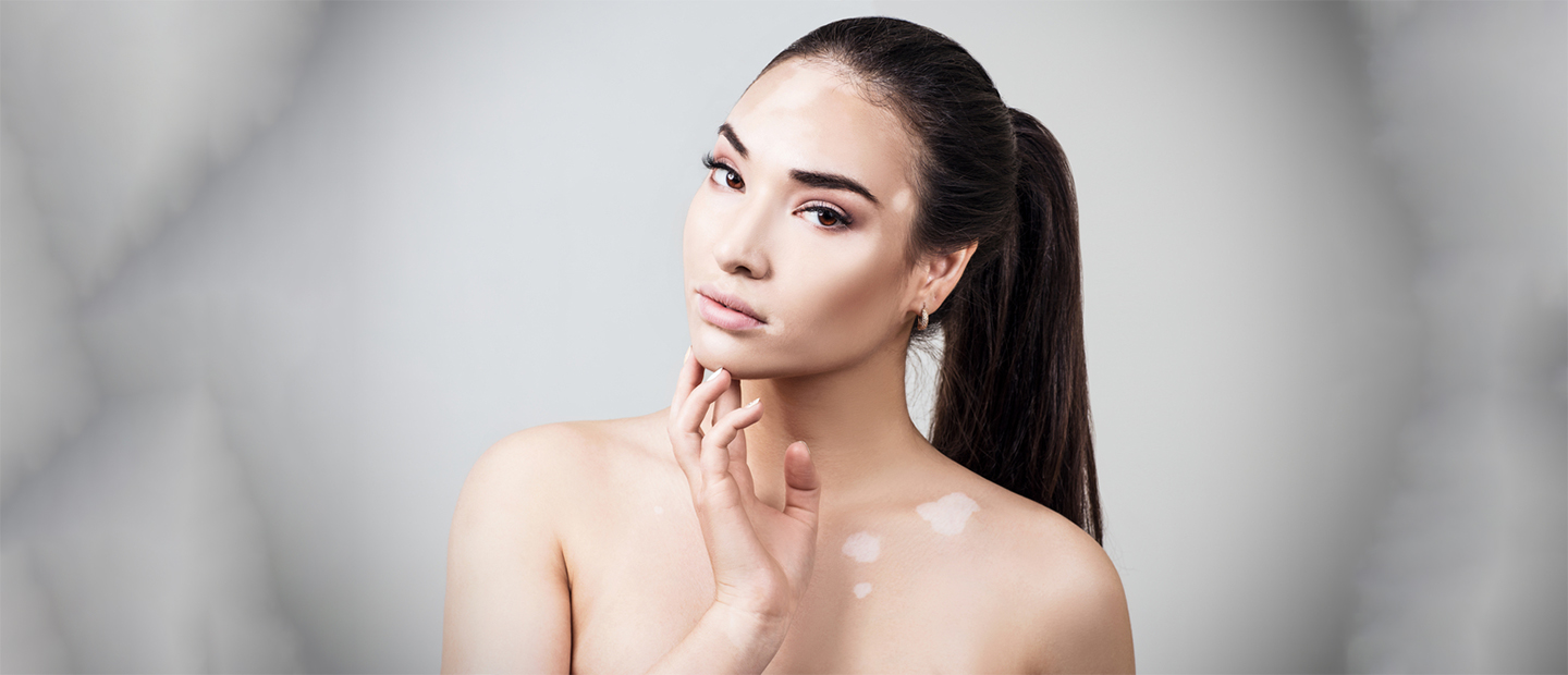 Vitiligo: cauze, manifestari, factori de risc, ameliorare