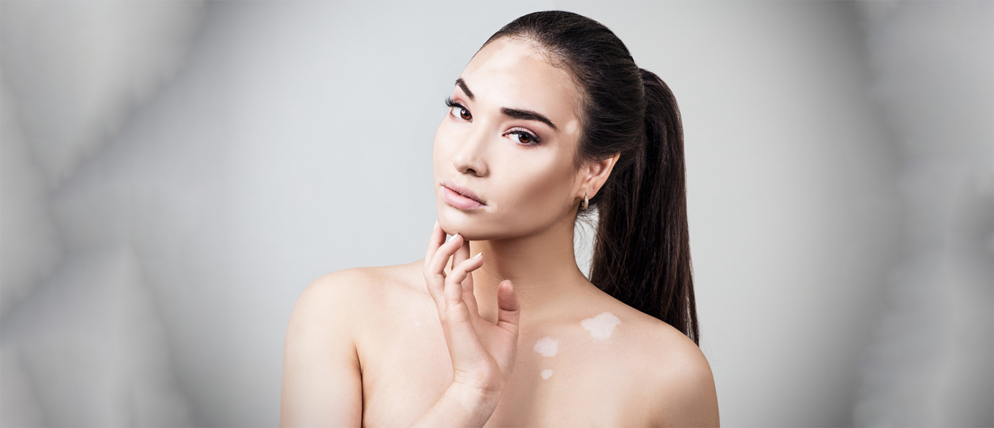 Vitiligo: cauze, manifestari, factori de risc, ameliorare