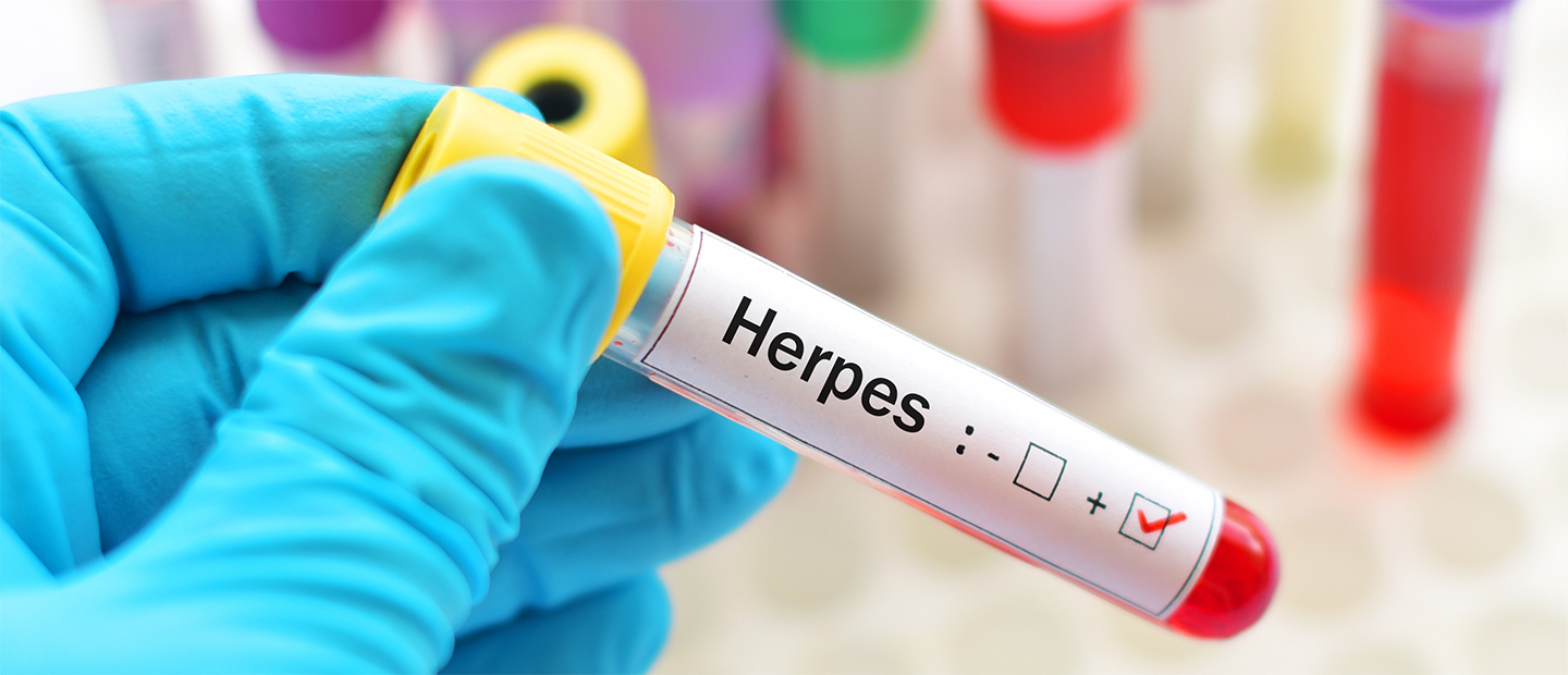 Herpes genital: cauze, simptome, tratament