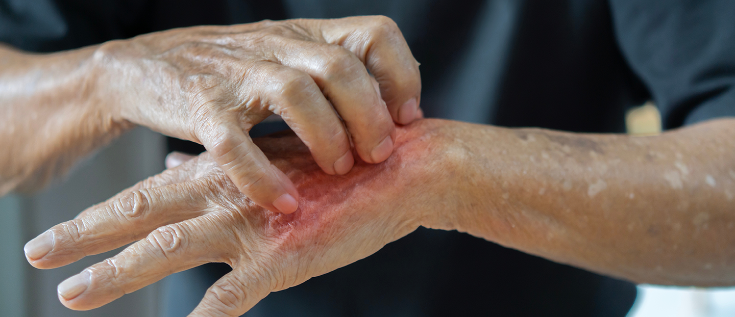 Scabia (raia la oameni) – simptome, tratament rapid si preventie