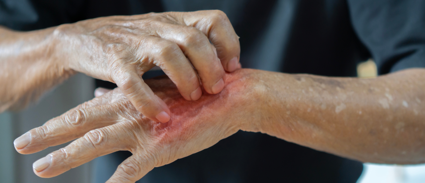 Scabia (râia la oameni): cum recunoști rapid simptomele, care este tratamentul eficient și cum previi reinfectarea