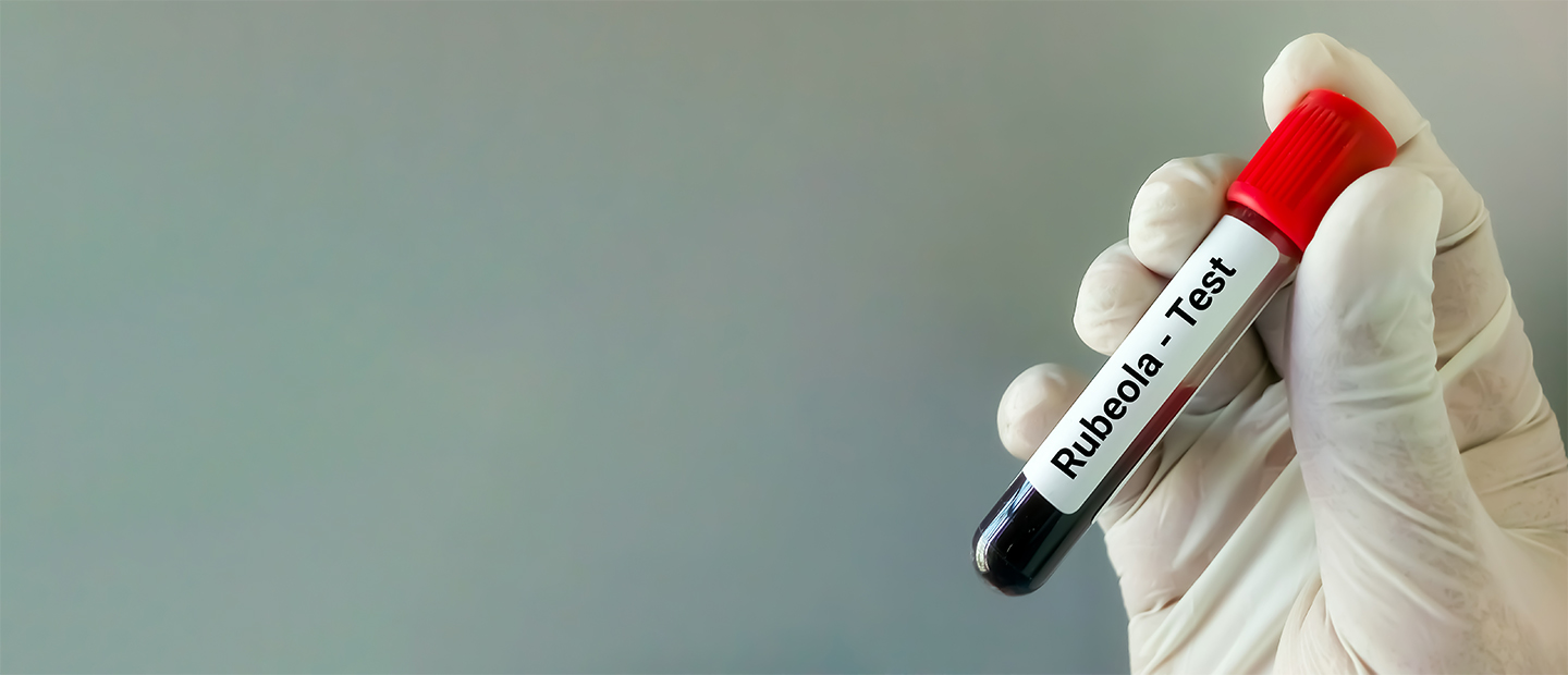Rubeola: caracteristici, tipuri, cauze, tratament