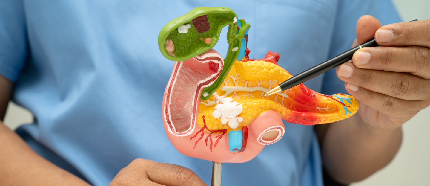 Cancerul de pancreas: simptome pe care nu trebuie să le ignori și durata de viață după diagnostic