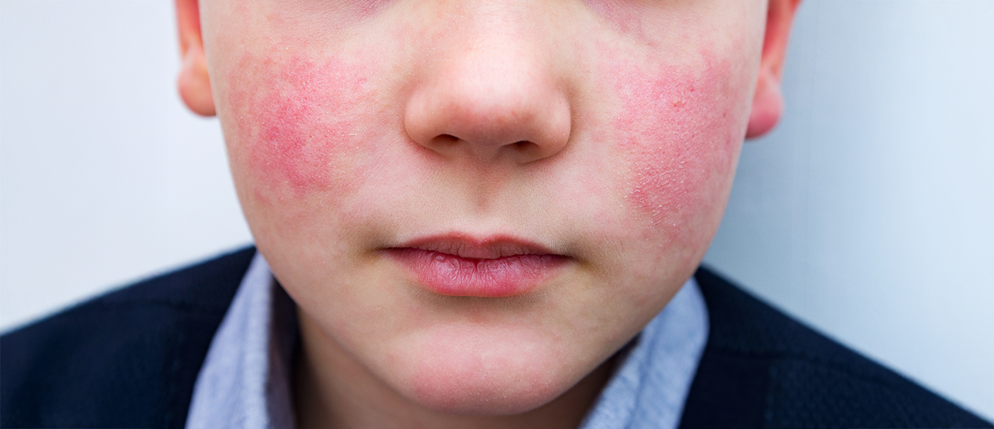Eritem infecțios (boala obrajilor pălmuiți): cauze, simptome, tratament
