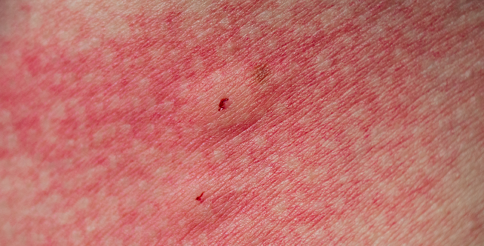 Urme de mușcătură de păianjen și roșeață în jurul ei