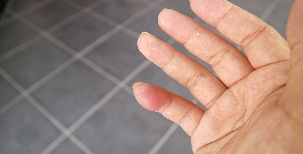 Mușcătură de păianjen veninos