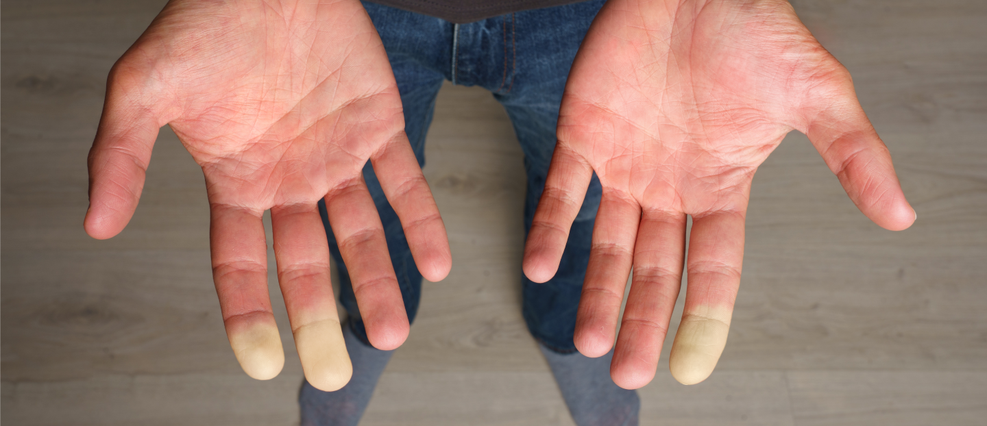 Sindromul Raynaud: cauze, simptome și tratament eficient. Când să faci analize pentru boli autoimune?
