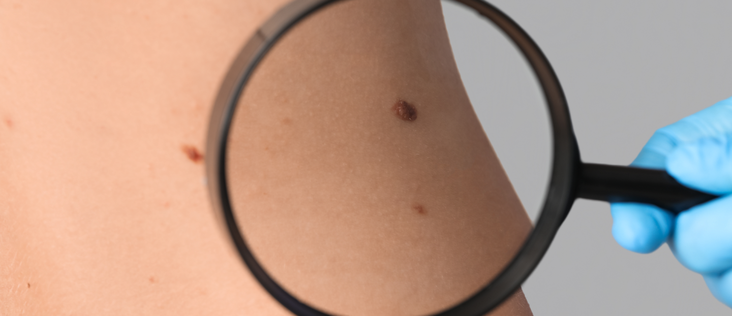 Totul despre alunițe cancerigene: ghidul tau complet de recunoaștere și prevenție