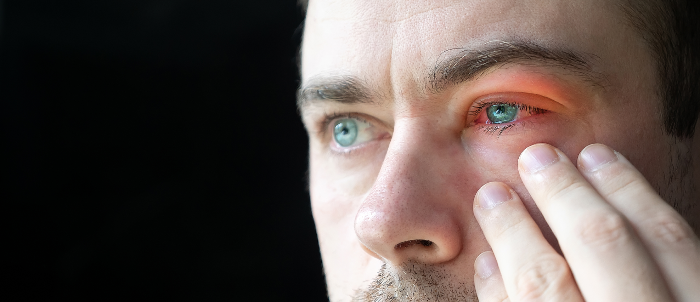 Ai pleoapa umflată și iritată? Află tot ce trebuie să știi despre blefarită