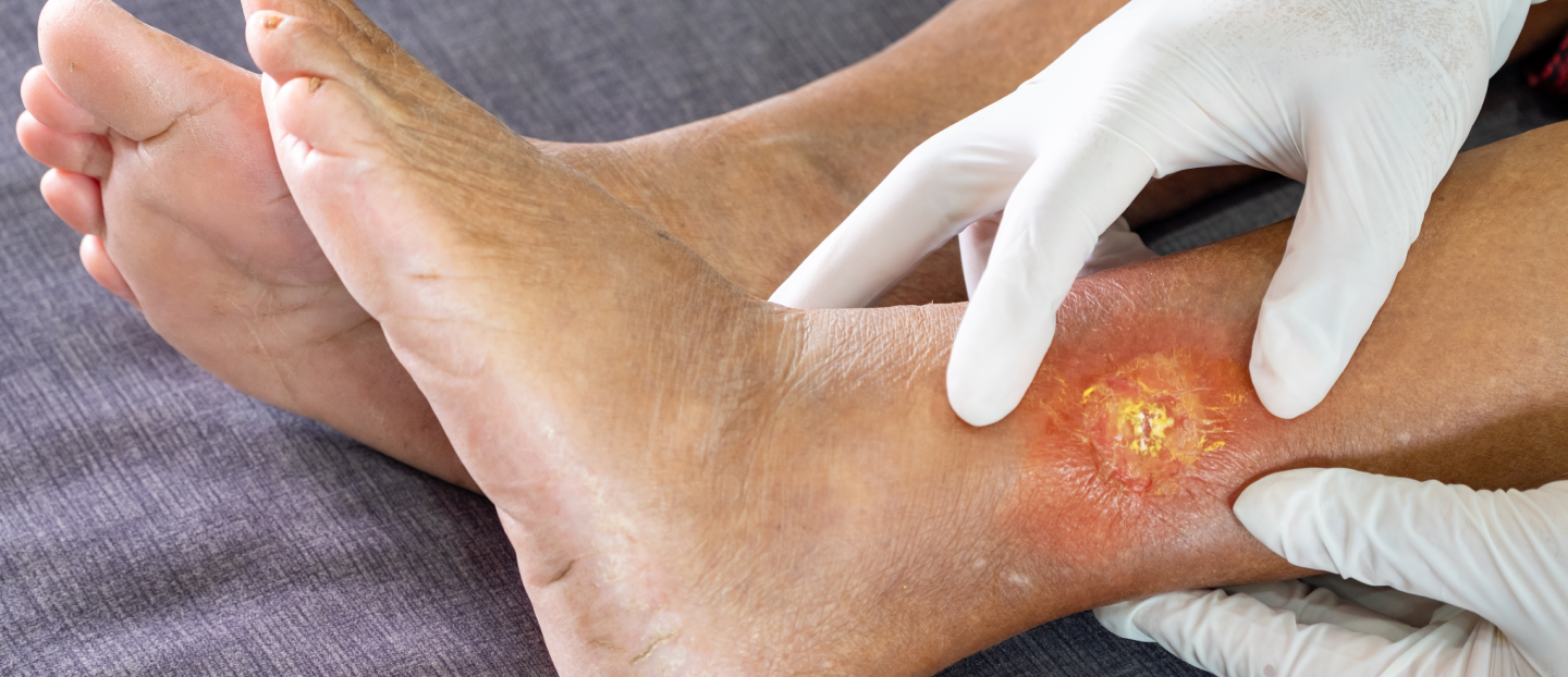 Gangrena: ghid complet despre cauze, simptome și opțiuni de tratament