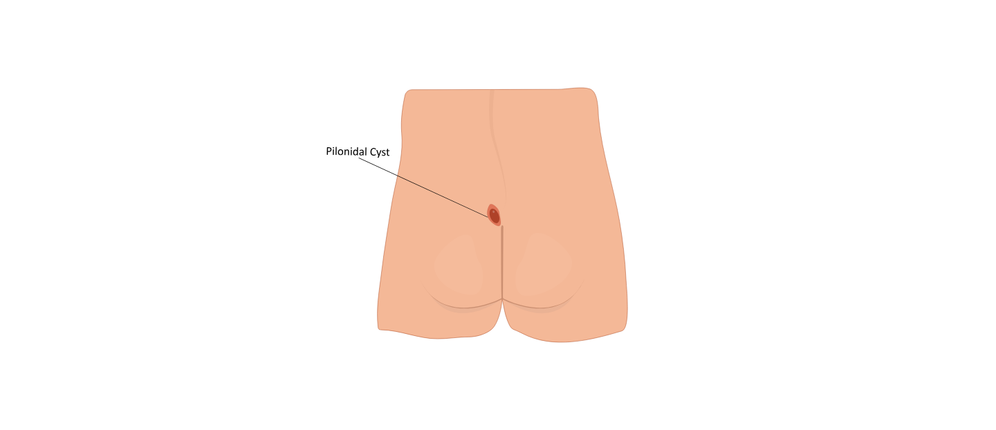 Ce este boala pilonidală, de ce apare și cum se tratează