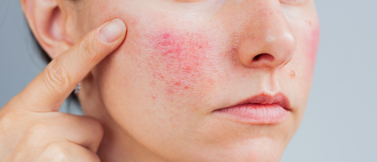 Rozaceea: de la roșeață la diagnostic și tratament. Află tot ce trebuie să știi despre această afecțiune cronică a pielii