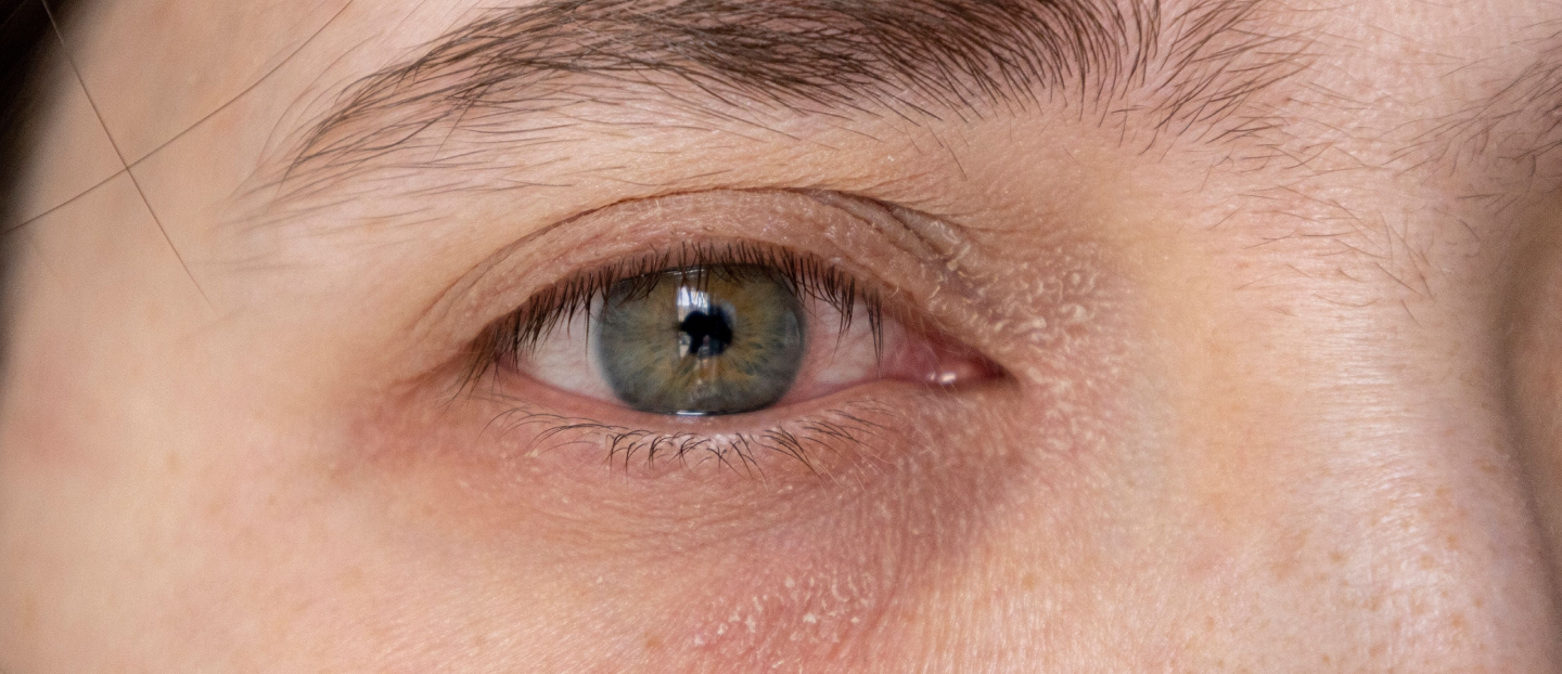 Ce este xeroftalmia (ochi uscat sever)? Cauze, analize de sânge și cum ajută lacrimile artificiale