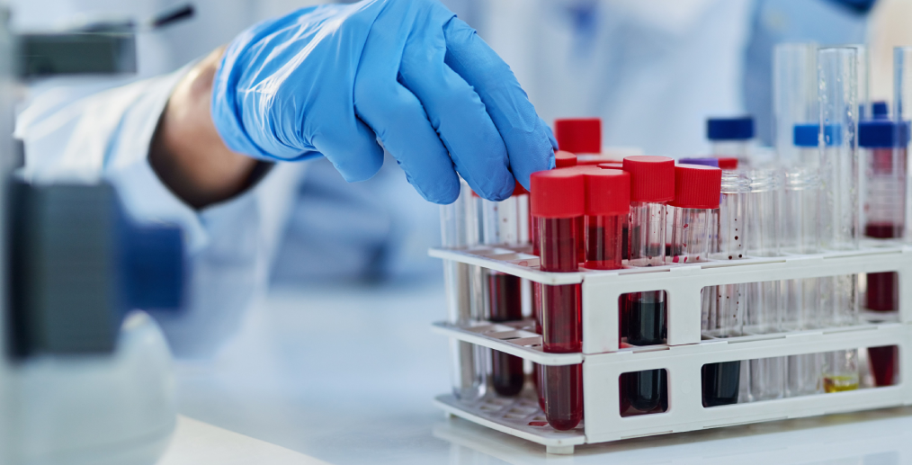 Analize markeri inflamatori