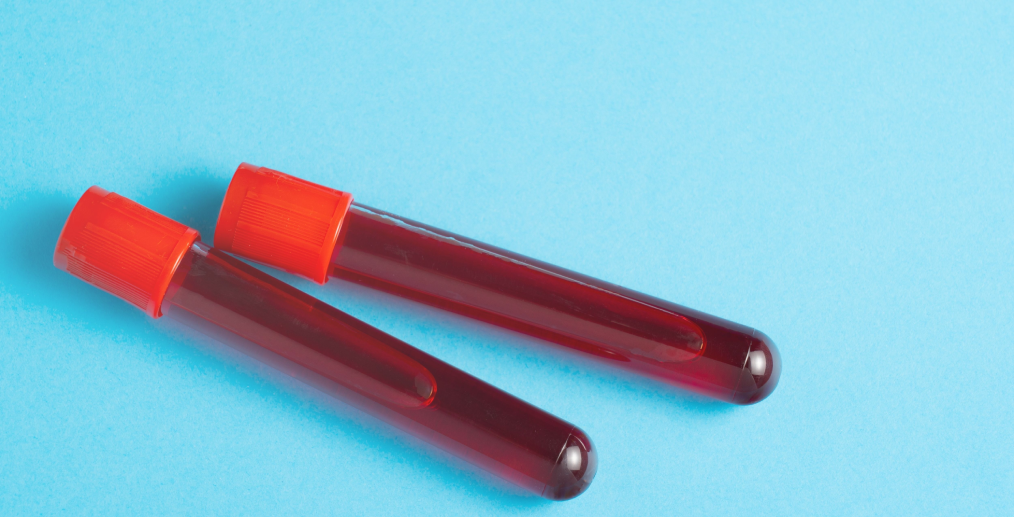 Analize pentru gust metalic în gură