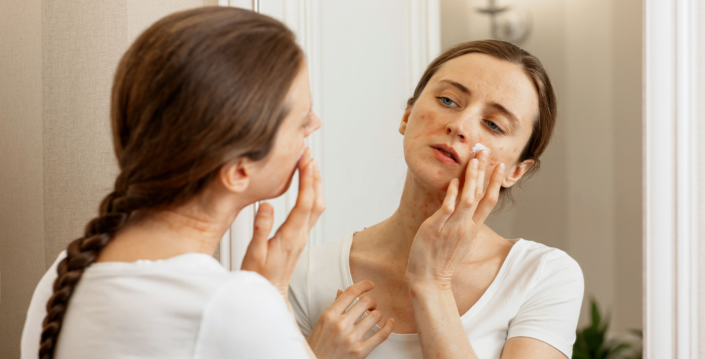 Hidratare piele descuamată