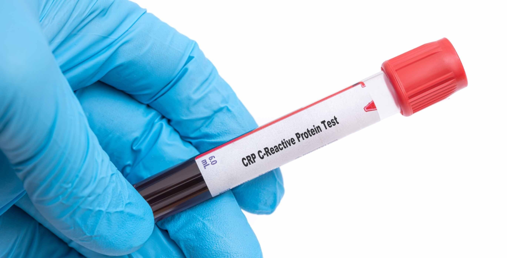 Proteina C reactivă - PCR