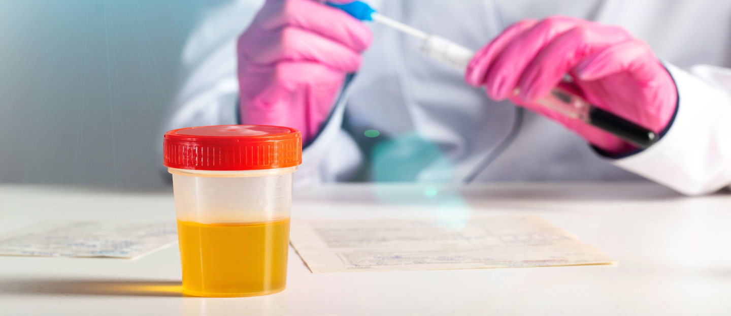 Mucus în urină: când este normal și când semnalează o infecție sau inflamație?