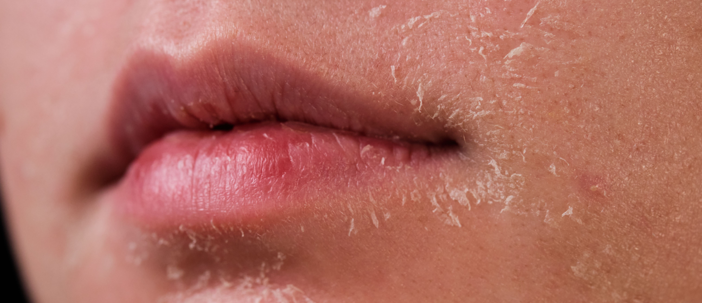 Uscarea și descuamarea pielii: care sunt principalele cauze și ce analize de sânge să faci?