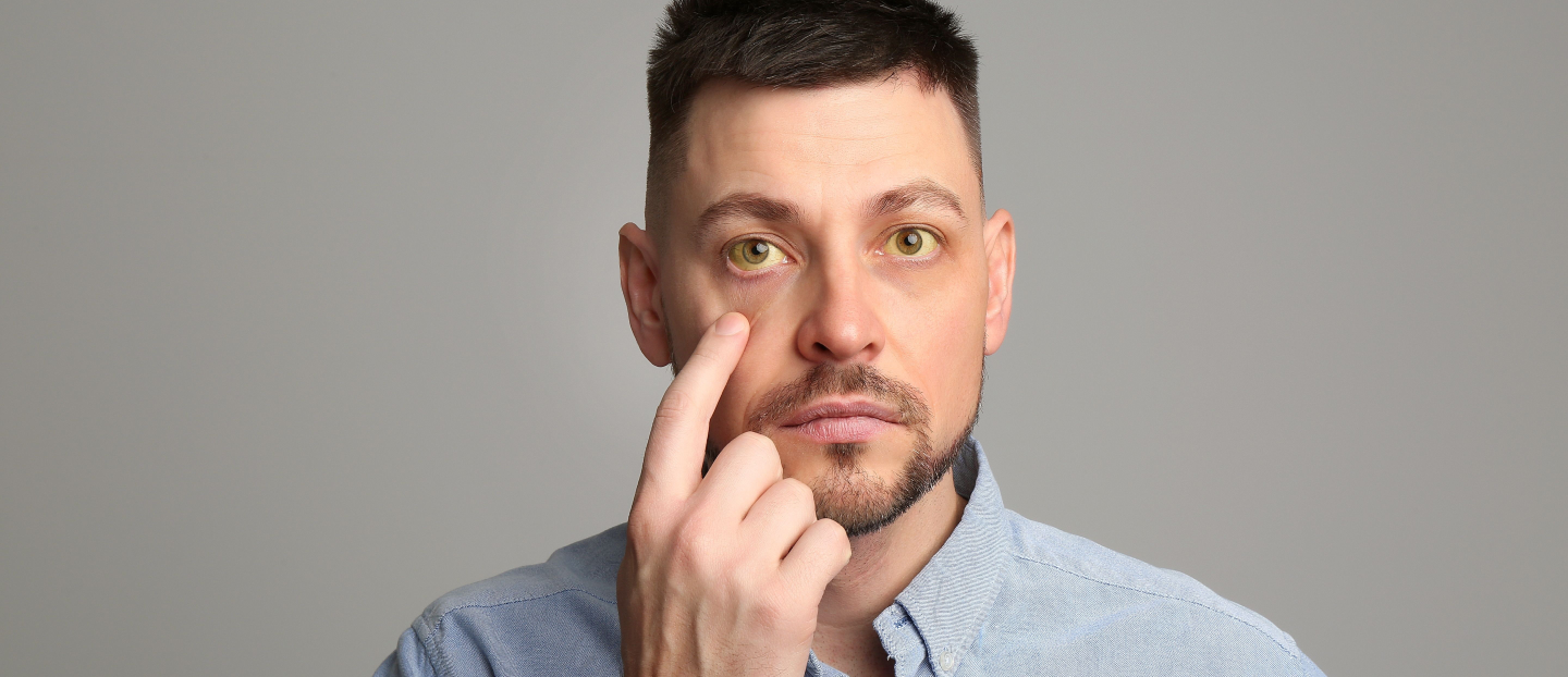 Icter: piele și ochi ingălbeniți. Ce analize hepatice sunt necesare de urgență?