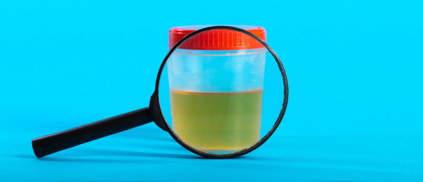 Urina verde sau albastră: ce cauze neașteptate poate avea și care sunt analizele recomandate?