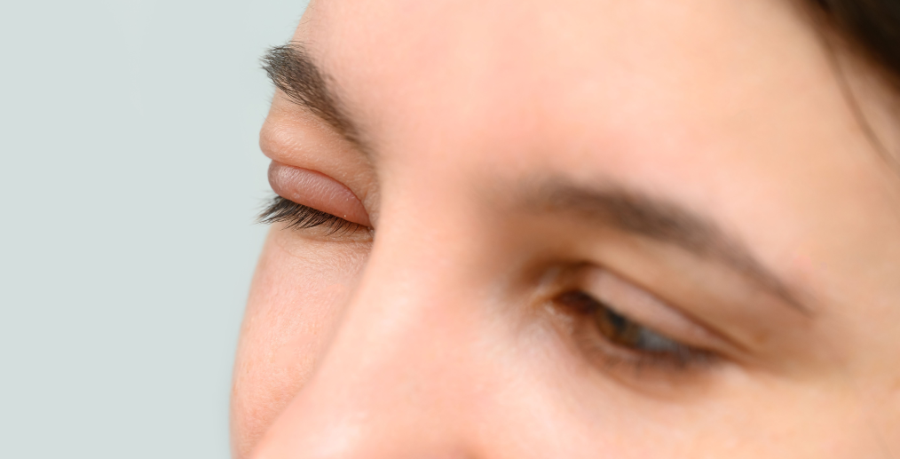 Umflături în zona pleoapelor