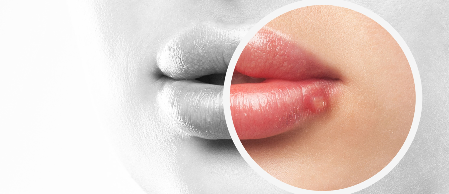 Herpes simplex: ghid complet despre infecția cu virusul herpetic