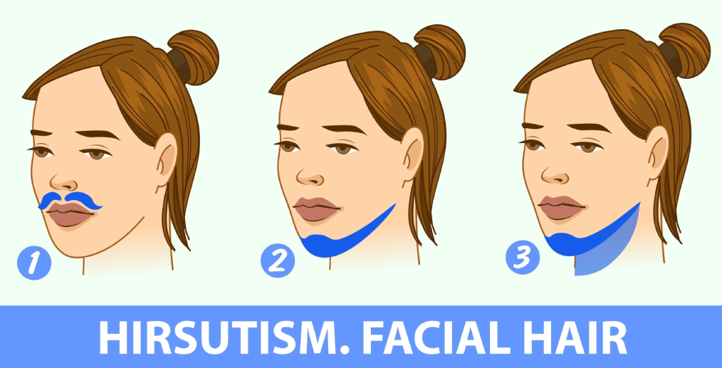 Localizarea părului facial în hirsutism