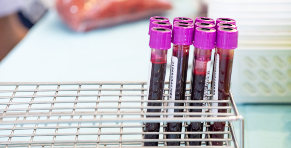 Analize hormonale pentru durerea de sâni