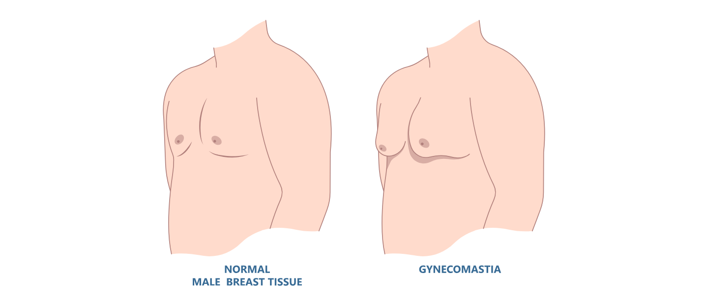 Ginecomastia (mărirea sânilor la bărbați): 4 analize hormonale esențiale pentru diagnostic
