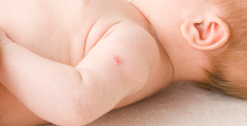 reactie vaccin copil