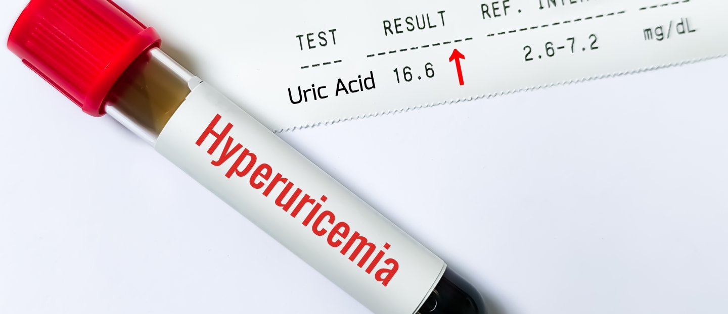 Hiperuricemia asimptomatică: când acidul uric crescut necesită tratament?