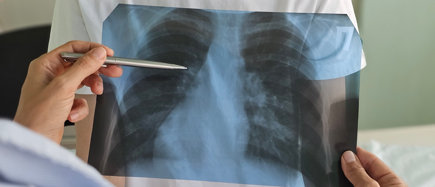 Cancer pulmonar: simptome, tipuri, stadii și cât se poate trăi după diagnosticare?