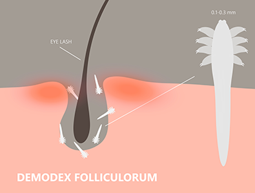 acarieni-demodex-ilustratie-medicala
