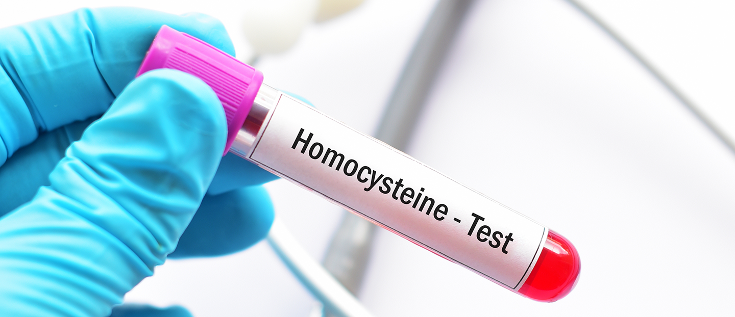 Hiperhomocisteinemia (homocisteina crescută): simptome, cauze, valori și tratament