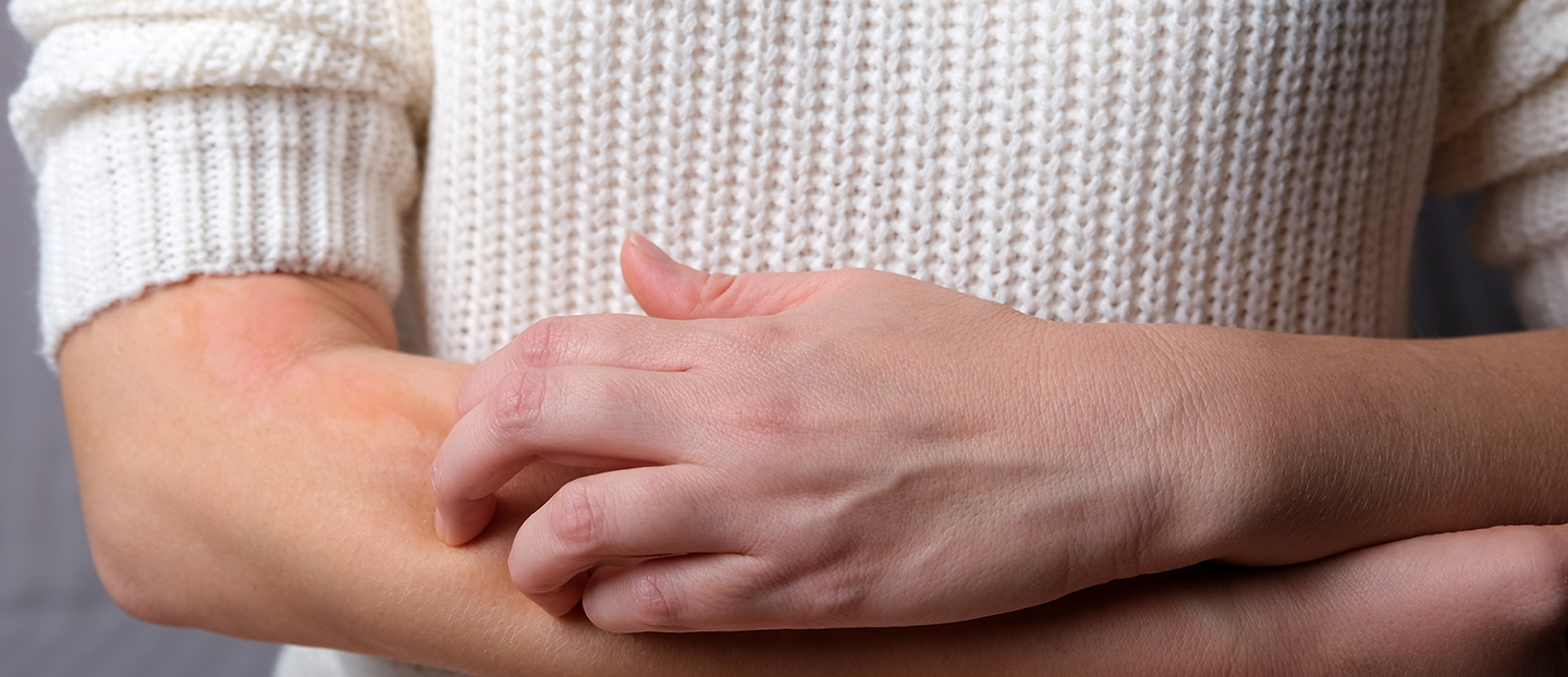 Neurodermatită: cauze, simptome, diagnostic și tratament