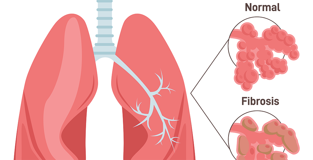 plamani-sanatosi-vs-fibroza