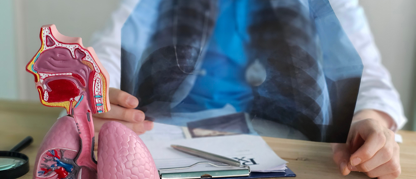 Fibroză pulmonară: ce este, simptome, cum se diagnostichează și cât se poate trăi cu această boală?