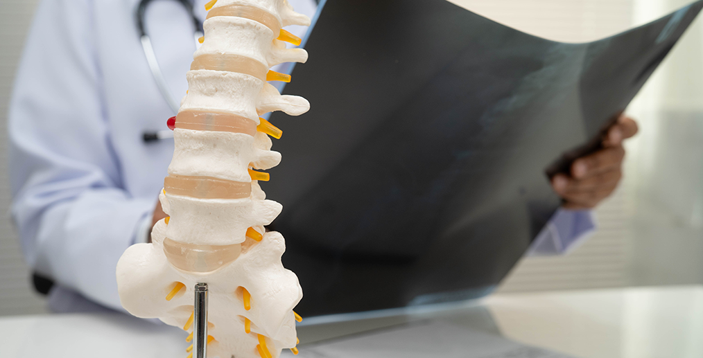 densitate-osoasa-osteoporoza