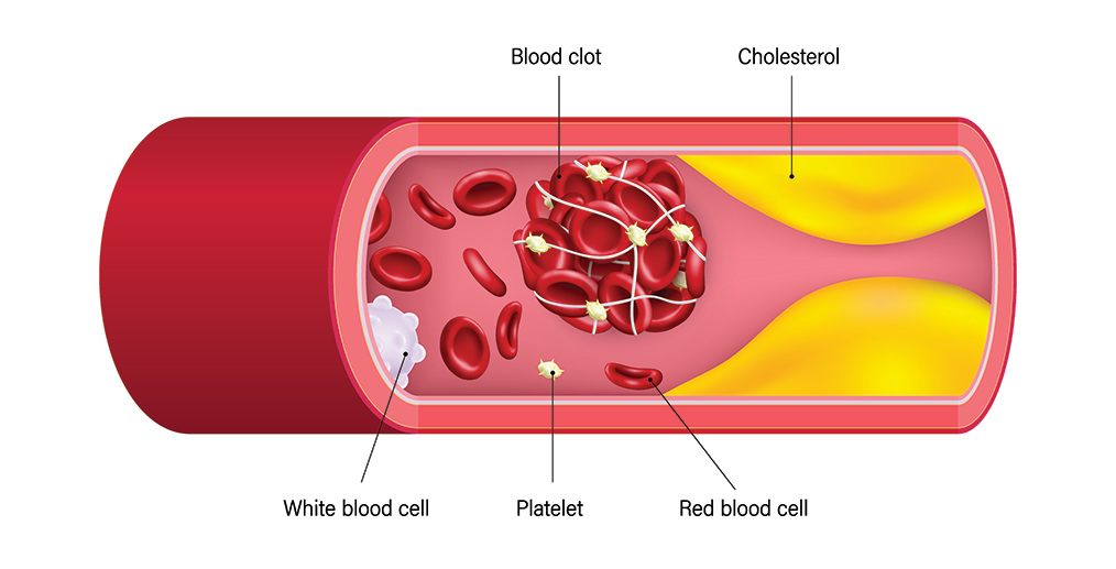 concept-medical-trombofilie